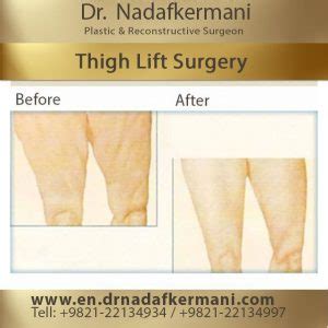 Thigh Lift Surgery 101: Everything You Need To Know